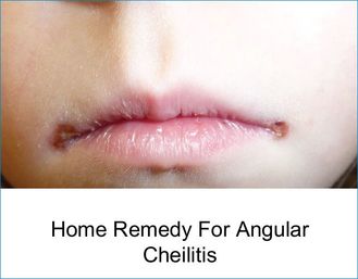 Natural Balms To Combat Angular Cheilitis